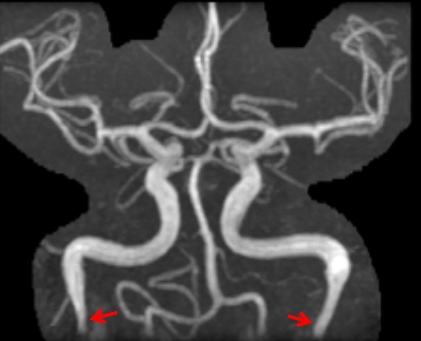 Pulsatile Tinnitus Carotid Artery Dissection